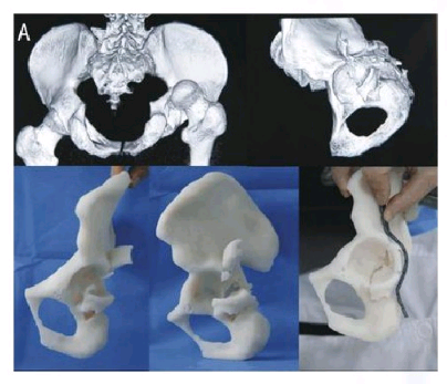 骨科3D打印機(jī)應(yīng)用